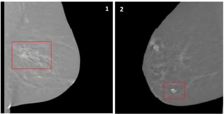 Microcalcifications on mammography