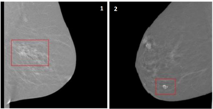 Micro_calcifications